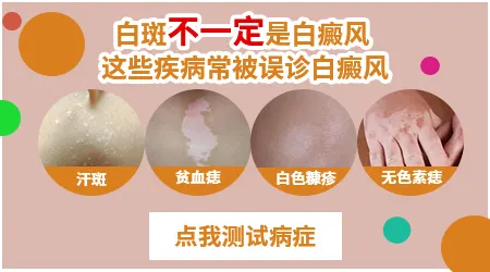 手部白癜风早期症状图片 手指白点是不是白斑