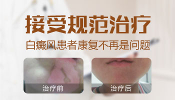 白癜风眉毛白了还能变黑吗