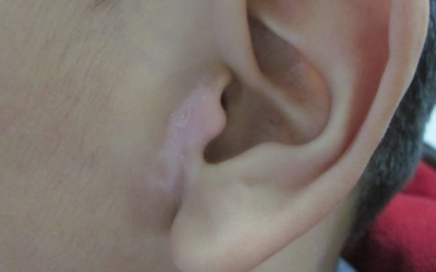 耳朵前面有白斑是不是白癜风