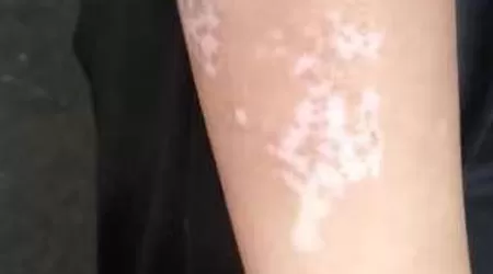 手上白斑初期的图片