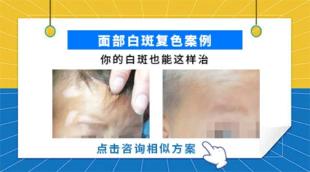 面部白癜风治疗3个月能复色吗