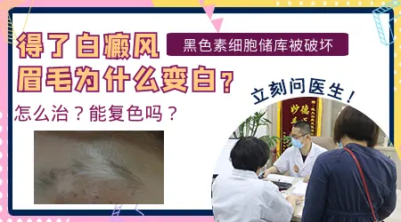 白癜风眉毛变白这个病情严重吗