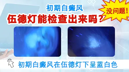 初期白癜风在伍德灯下会显示什么