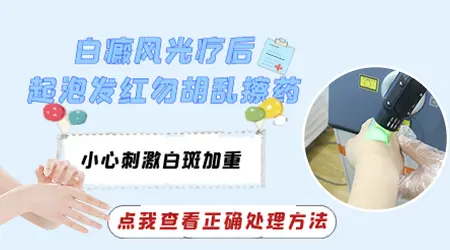 白斑照光发红什么时候好