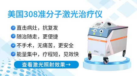 宝宝白癜风照激光能好吗