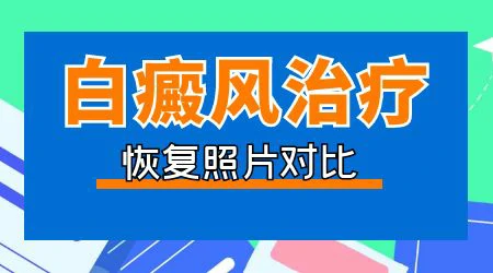 白癜风长在手背侧面好治吗