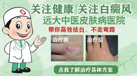 钱币大小白癜风能治疗好吗
