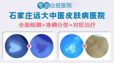 白斑边界模糊是白癜风早期吗