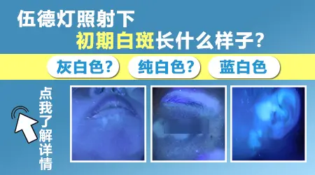 白癜风白斑在wood灯下什么样