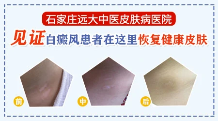白斑照308激光恢复过程图