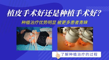 白癜风做黑色素细胞种植和传统植皮有什么区别