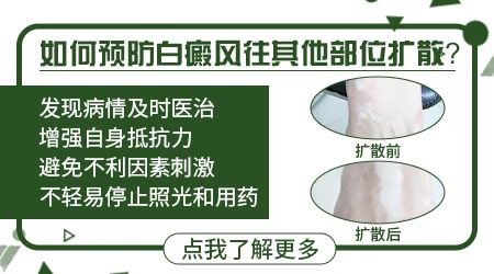 白癜风小白点早期怎么控制不扩散