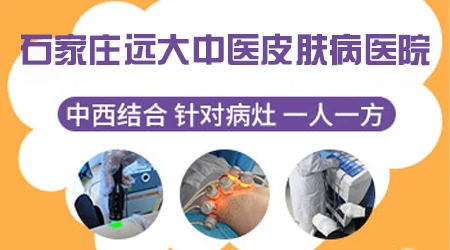 石家庄中西医结合治白癜风好的医院