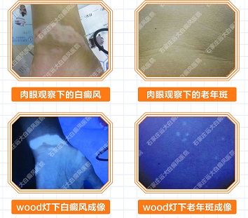 色素脱失和白癜风的区别是什么