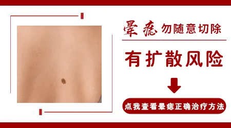 晕痣型白癜风怎么治疗效果好