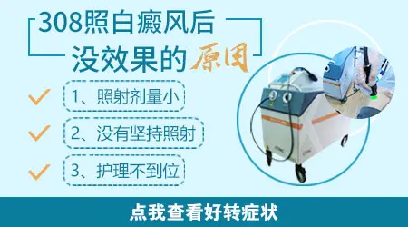 手指白癜风照308半年没好转还继续照吗