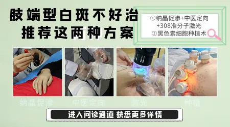 手脚肢端的白斑是不是真的很难治好