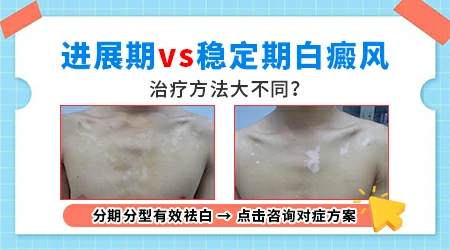 如何判断白癜风是进展期还是稳定期
