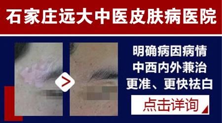 石家庄治疗白癜风有名的专家是谁