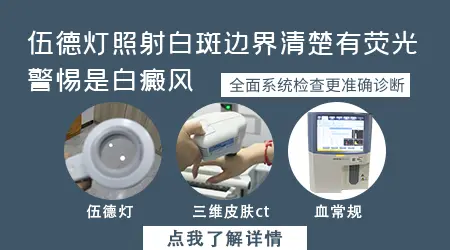伍德灯检查白斑呈亮白色就是白癜风吗