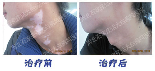 <a href=https://www.bdfcctv.com/sjzbdfyy/ target=_blank class=infotextkey>石家庄白癜风医院</a>——熬夜及过度劳累等会导致白癜风