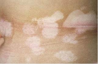 发展期的白癜风会引起皮肤癌吗