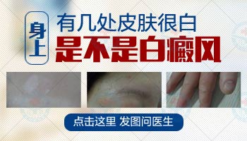 白斑害怕是白癜风该怎么办