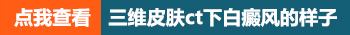 正常皮肤与白癜风皮肤在美国三维皮肤ct下的对比图片