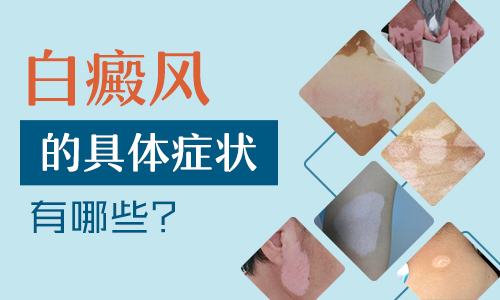 婴儿正常白斑图片