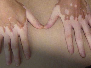 手部出现白斑后应该如何正确进行治疗