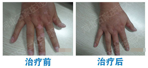手指白癜风植皮手术后恢复图