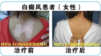 一年之计在于春——春季<a href=https://www.bdfcctv.com/zhiliao/ target=_blank class=infotextkey>白癜风治疗</a>迫在眉睫!
