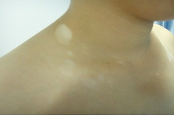 脖子上黄豆大小白斑能治好吗