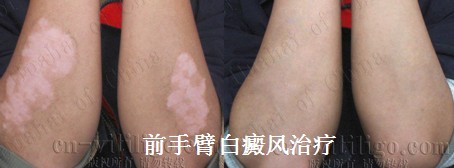 女性泛发型白癜风症状