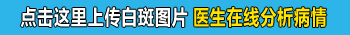 白癜风照308激光一个疗程白斑只发红是怎么回事