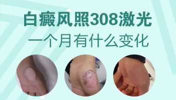 晕痣性白斑可以照308激光吗效果如何