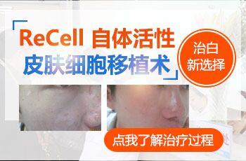 2019白癜风治疗新方案的方法是什么